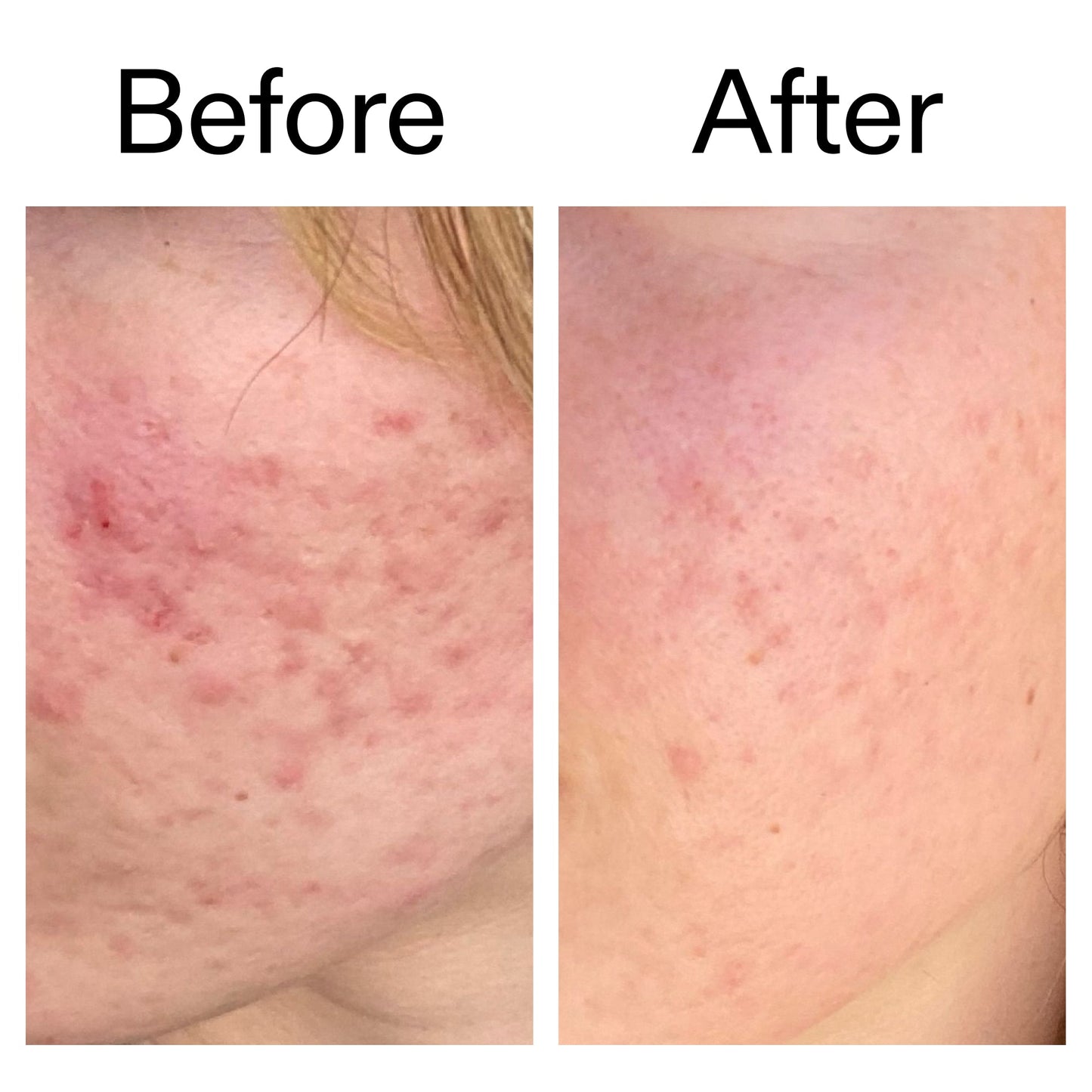 10-azelaic-acid-serum-for-redness-relief-d9 Azealic_Acid_Serum_B_A_Ppage_2000_x_2000.jpg