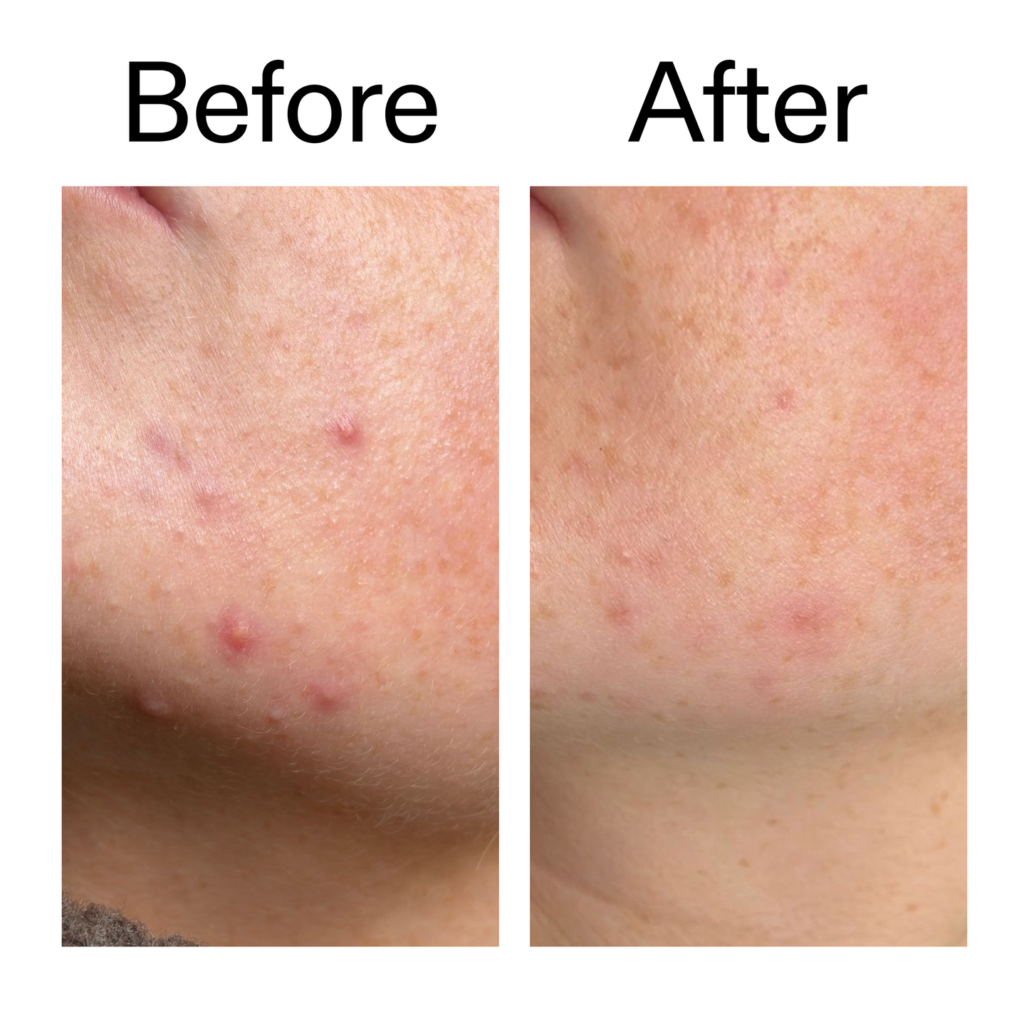 10-azelaic-acid-serum-for-redness-relief-d9 B_A_1_PPAGE.png
