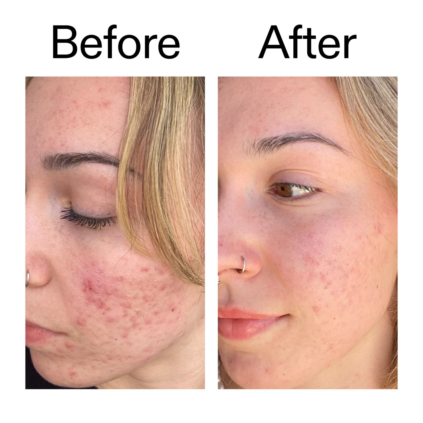 10-azelaic-acid-serum-for-redness-relief-d9 B_A_2_PPAGE.png