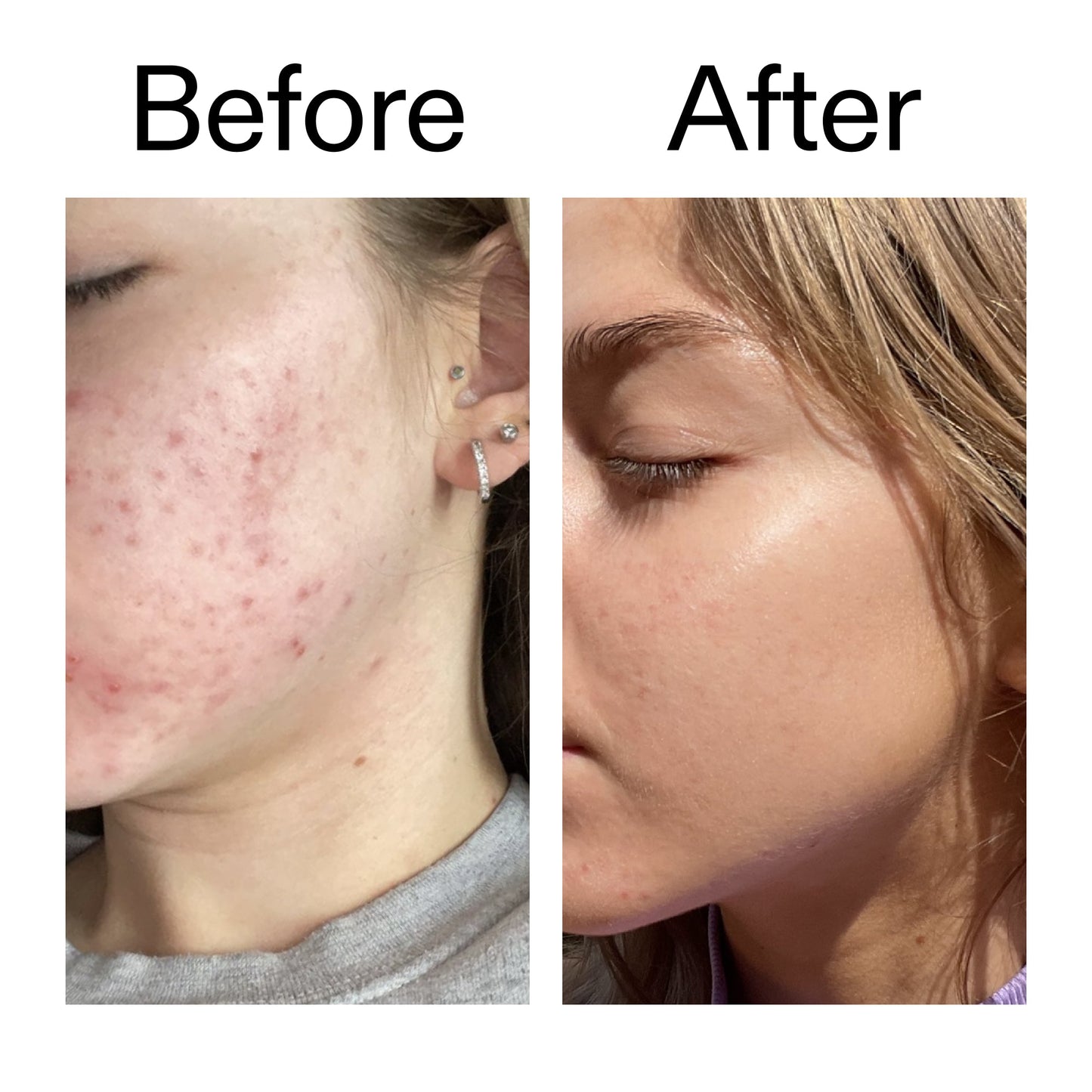 beta-hydroxy-acid-bha-serum-w8 Beta_Hydroxy_Acid_Serum_Before_After_2000x2000_96fda3e5-938d-49ef-bcf2-a0fa6ece4e2c.jpg