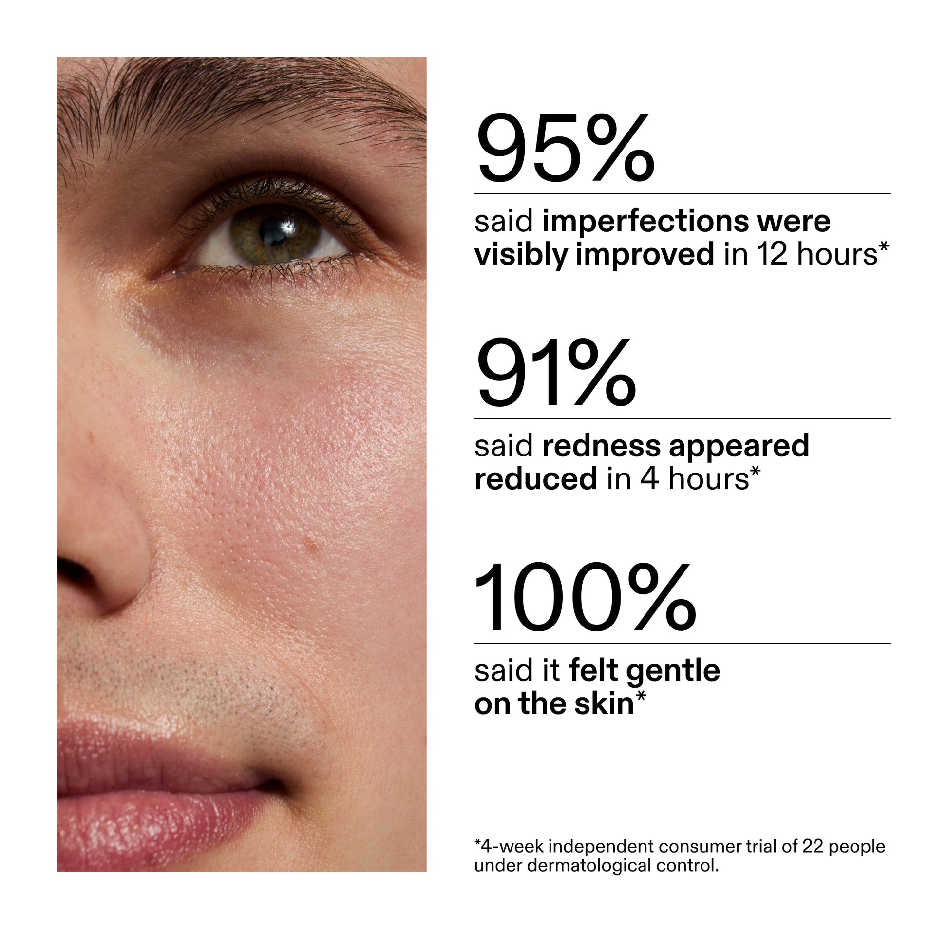 succinic-acid-acne-treatment-w8 CA_Succinic_Acid_Treatment_key_Claims_2000x2000_db91b0f1-7f29-4bfe-bb16-63a47f500960.jpg