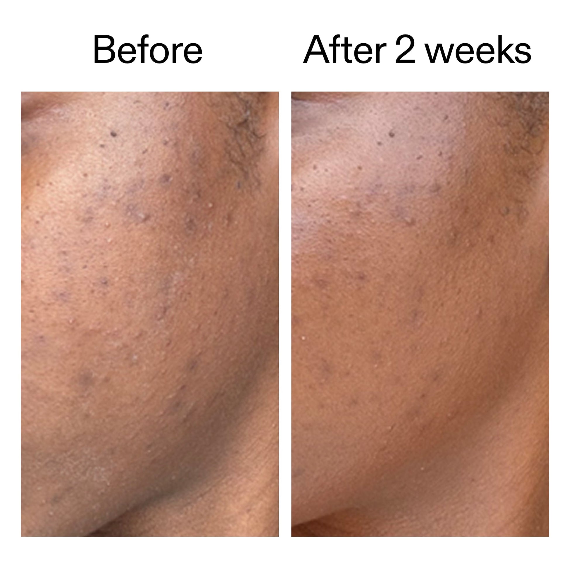 360-acne-clearing-duo-e9 DIOICB_A2000x2000.jpg