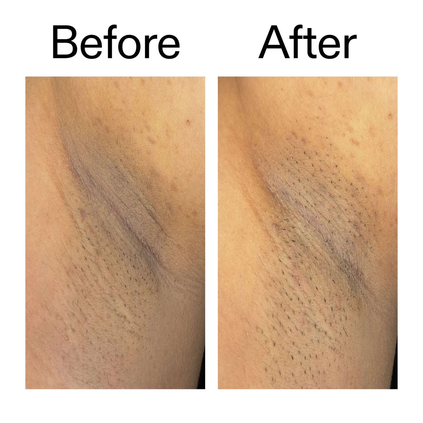 glycolic-acid-exfoliating-body-stick-duo-o9 Glycolic_Acid_Exfoliating_Body_Stick_Before_After_V3_2000x2000_ea919cd9-1439-4a46-82a0-76200eb5bb42.jpg