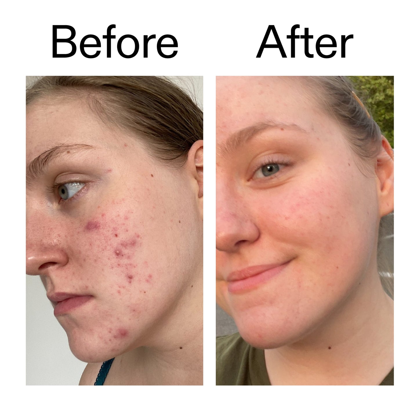 glycolic-acid-toner-w2 Glycolic_Acid_Toner_Before_After_2000x2000_49f0b9f7-e71b-4b2e-a8f8-2ea4b73247bb.jpg