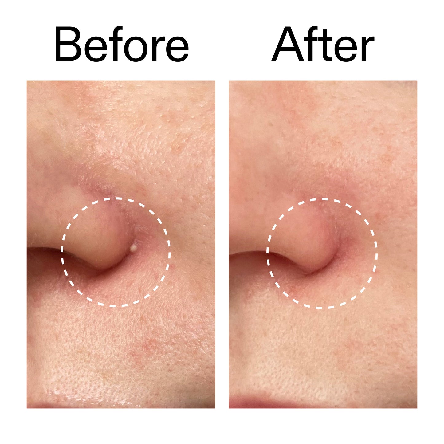 hydrocolloid-invisible-pimple-patches-pack-of-44-s5 Hydrocolloid_Invisible_Pimple_Patches_Before_After_2000x2000_b02aa37b-c78a-4682-91de-9135af5bb7df.jpg