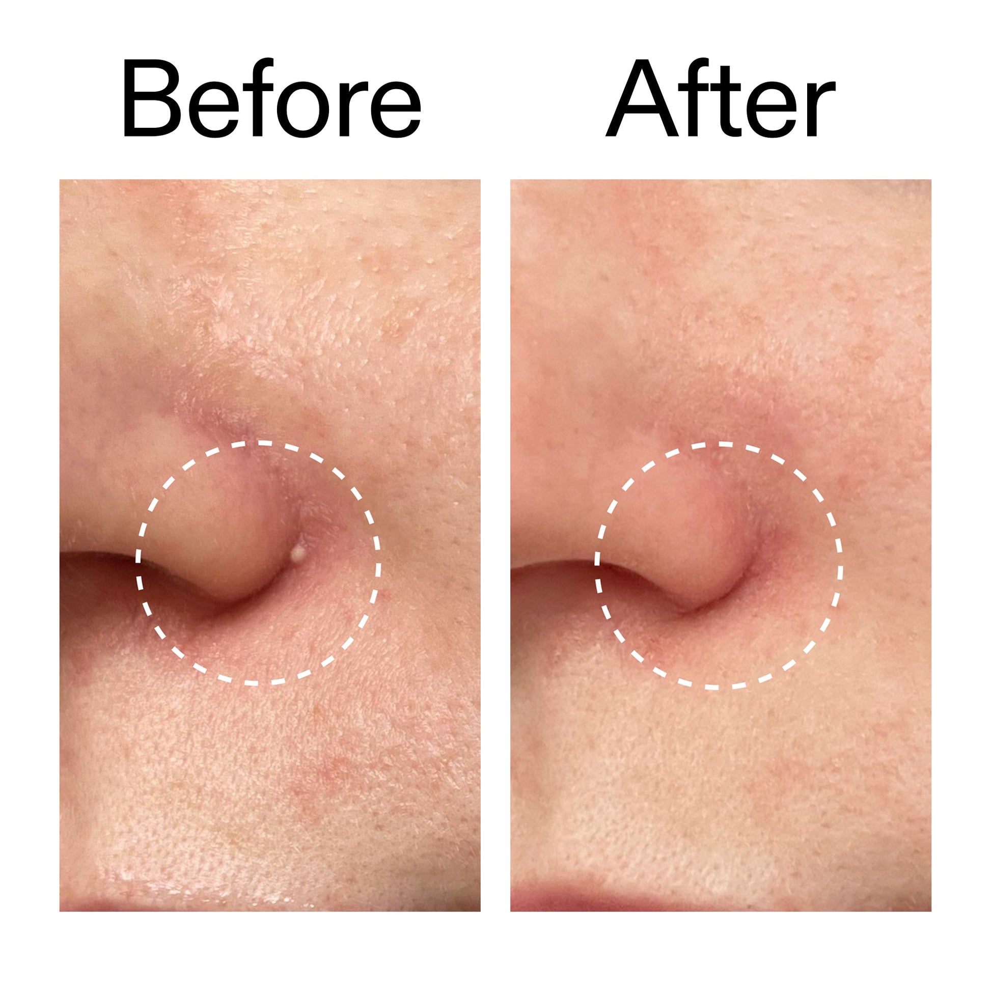 hydrocolloid-invisible-pimple-patches-pack-of-44-s5 Hydrocolloid_Invisible_Pimple_Patches_Before_After_2000x2000_b02aa37b-c78a-4682-91de-9135af5bb7df.jpg