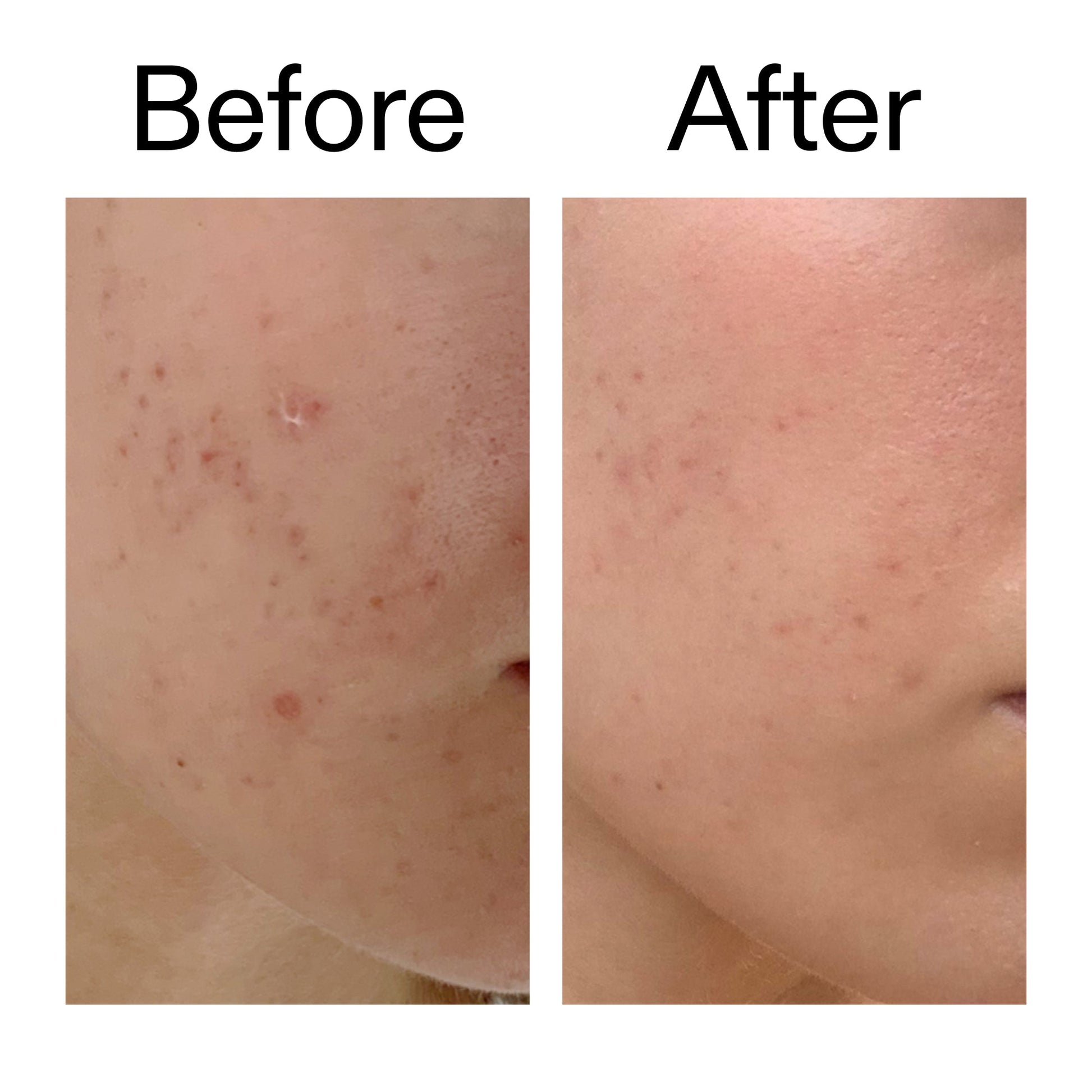 mandelic-acid-treatment-j5 Mandelic_Acid_Treatment_Before_After_2000x2000_4885ac6e-c5d7-4279-a72a-1417af7dce35.jpg