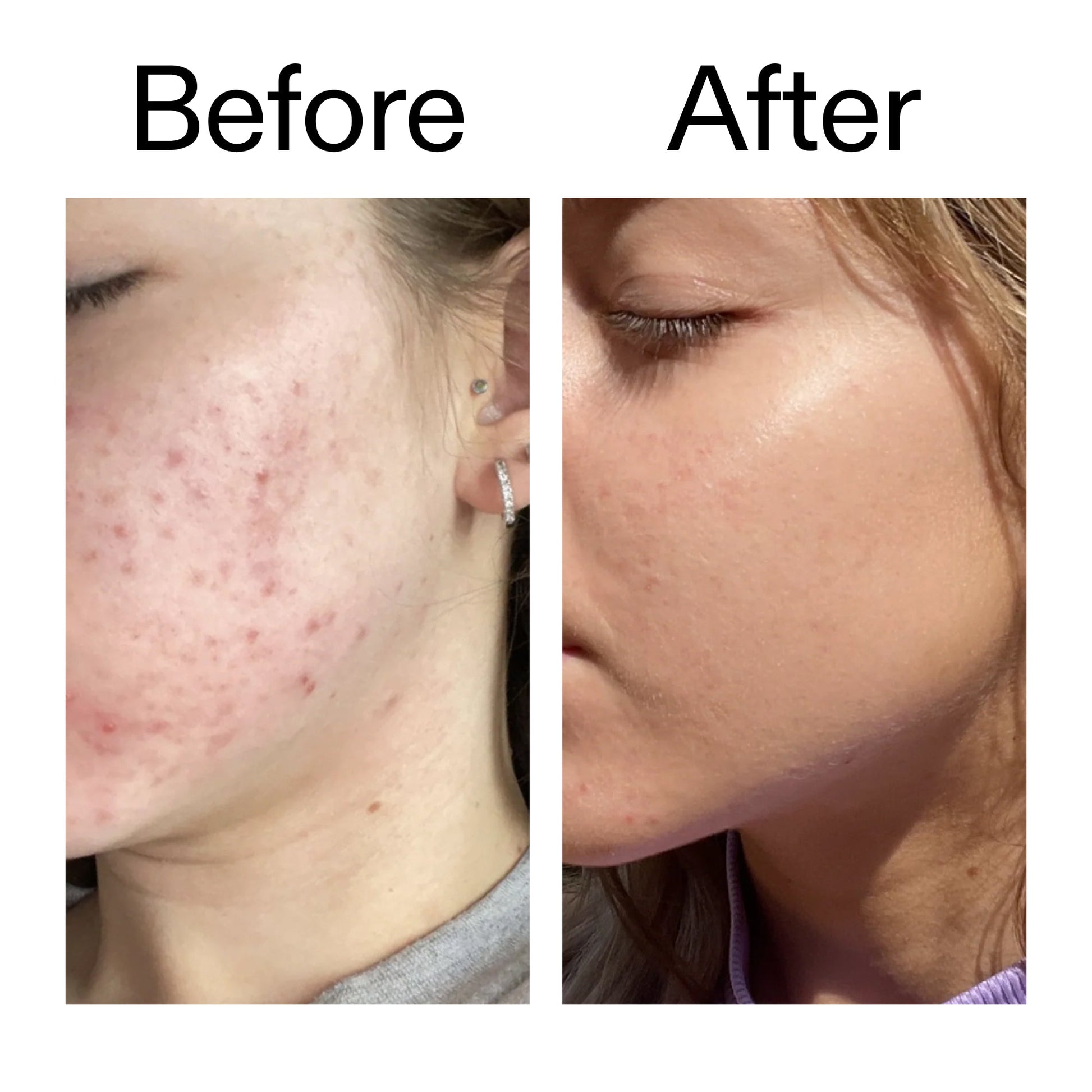 10-niacinamide-serum-duo-w2 Niacinamide_Serum_Before_After_2000x2000_bde32455-9e7d-448e-b053-bef41504f0a9.jpg