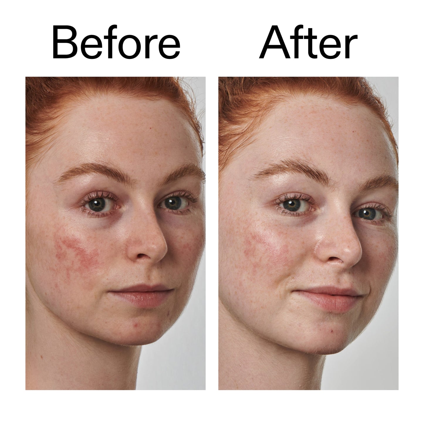 10-azelaic-acid-serum-for-redness-relief-d9 Redness_Relief_Serum_Before_After_2000x2000_3334dc9a-cce9-4e00-8aec-7ad89ca051f2.jpg