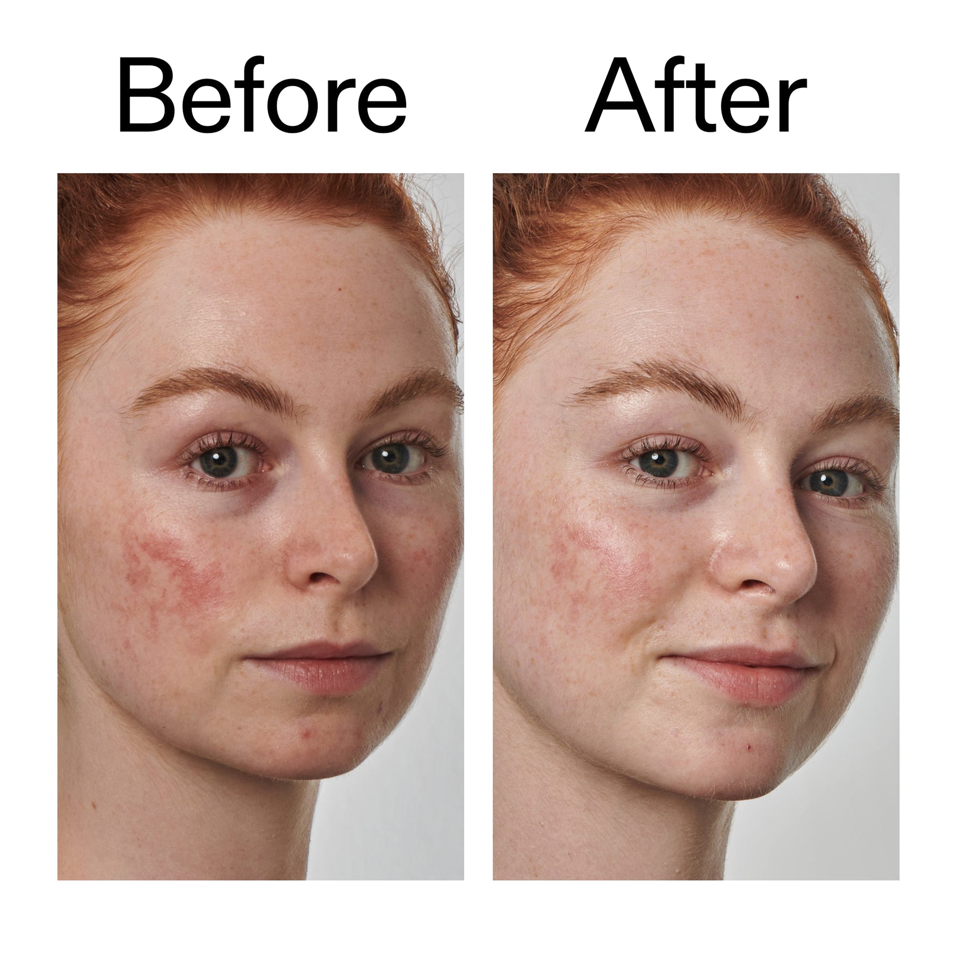 10-azelaic-acid-serum-for-redness-relief-d9 Redness_Relief_Serum_Before_After_2000x2000_3334dc9a-cce9-4e00-8aec-7ad89ca051f2.jpg