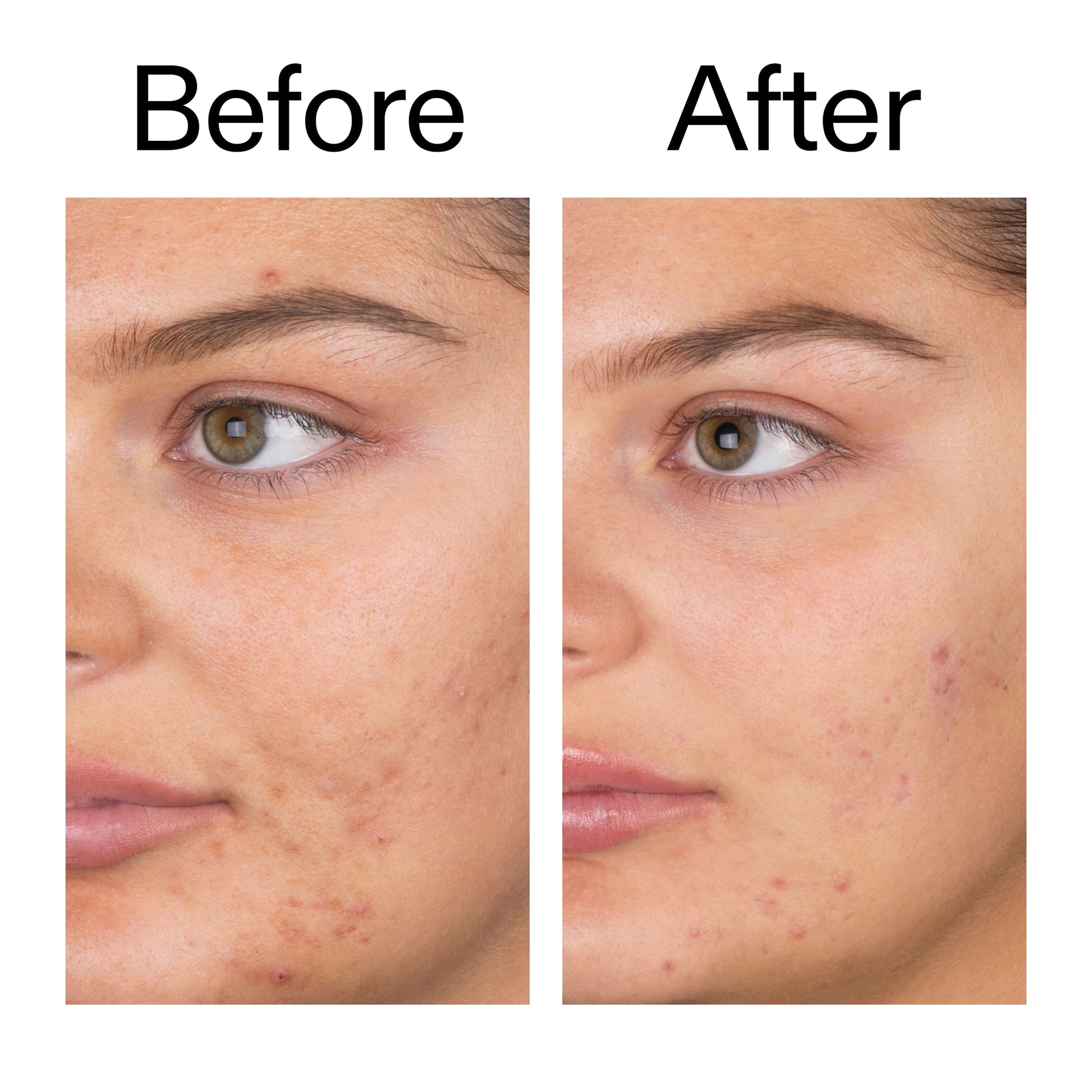 salicylic-acid-cleanser-150ml-n8 Salicylic_Acid_Cleanser_-_150ml_Before_After_2000x2000_e7230494-853f-4b07-82b1-27669104c995.jpg