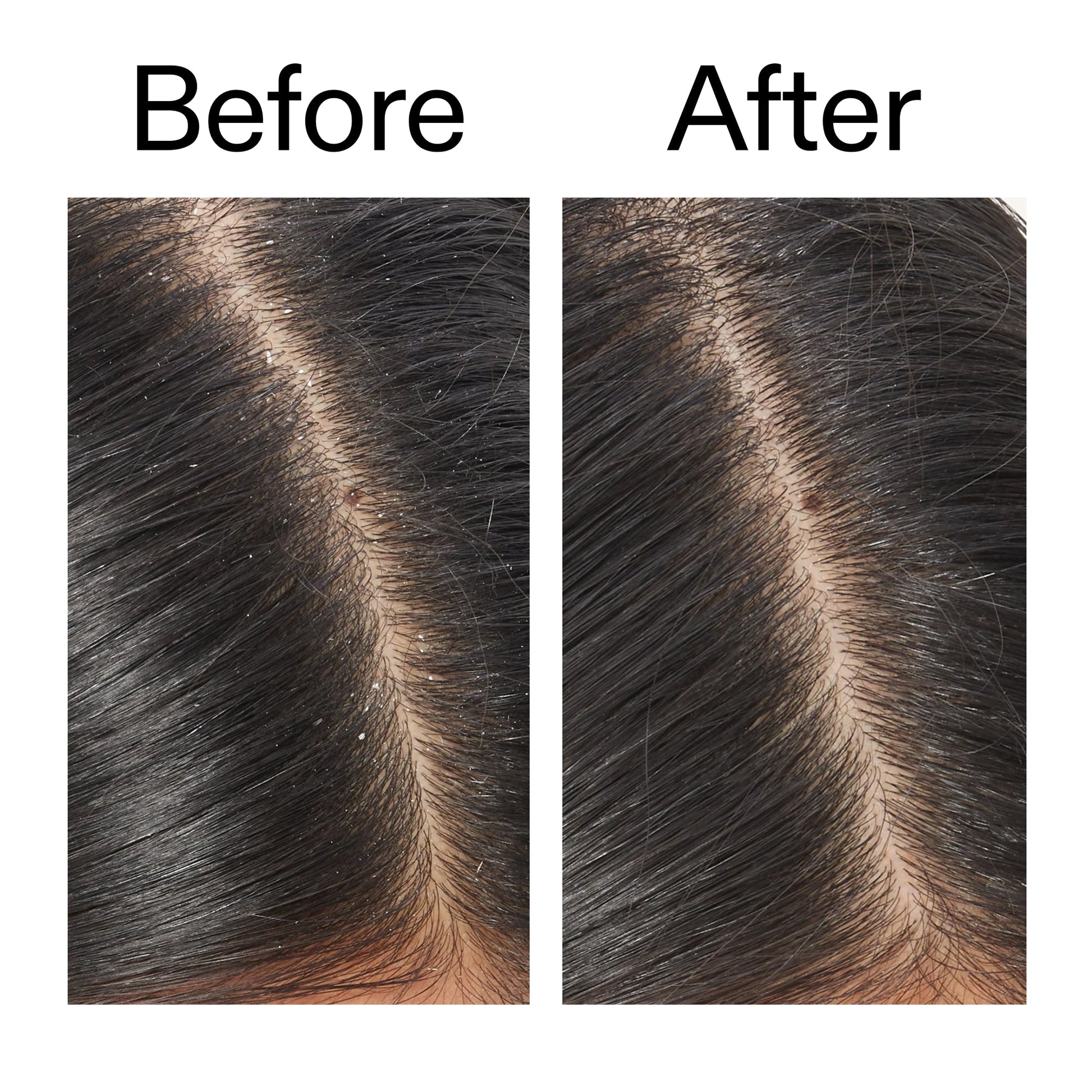 salicylic-acid-exfoliating-scalp-treatment-c9 Salicylic_Acid_Exfoliating_Scalp_Treatment_Before_After_V2_2000x2000_02bd61ad-42bf-490b-b3e3-7e04b2e8a673.jpg