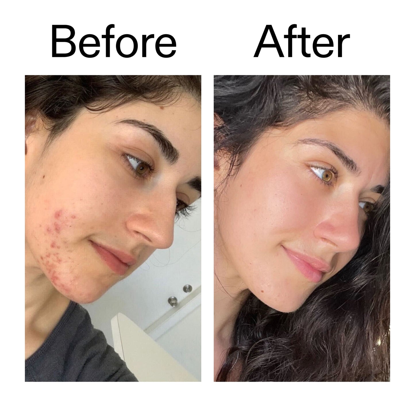succinic-acid-acne-treatment-w8 Succinic_Acid_Treatment_Before_After_2000x2000_6a5f0054-2f58-4433-9314-0dc72c9bdd3b.jpg