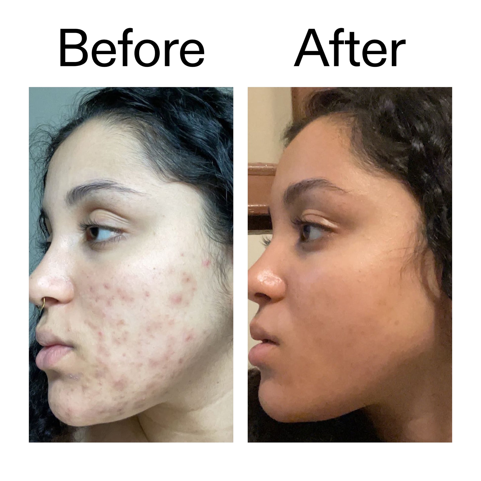 tranexamic-acid-serum-s9 Tranexamic_Acid_Serum_Before_After_2000x2000_98ebc8be-77b0-4843-8a22-90790ebe918b.jpg